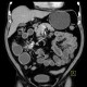 Carcinoid of terminal ileum, mesentery, desmoplastic reaction, prestenotic dilatation: CT - Computed tomography